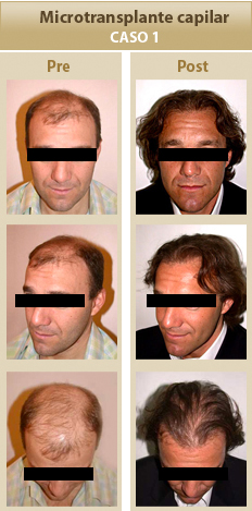 Capilar Caso 1