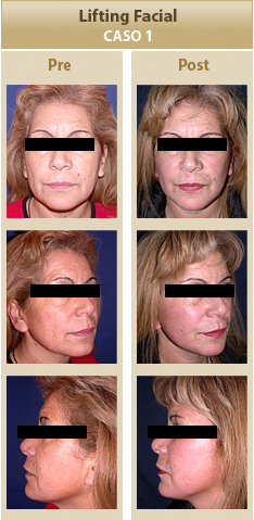 Cirugia Facial