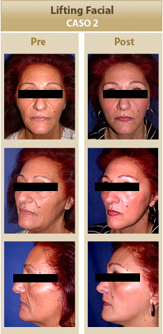 Cirugia Facial