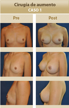 Cirugia mamaria