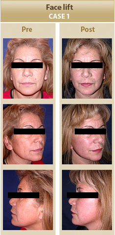 Cirugia Facial